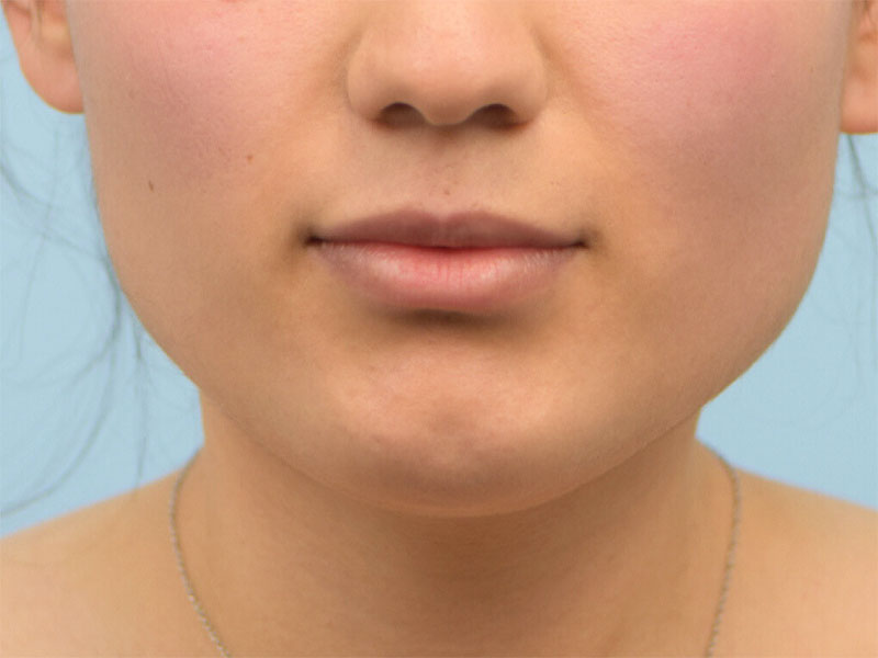 Augmentation Genioplasty Before & After Image
