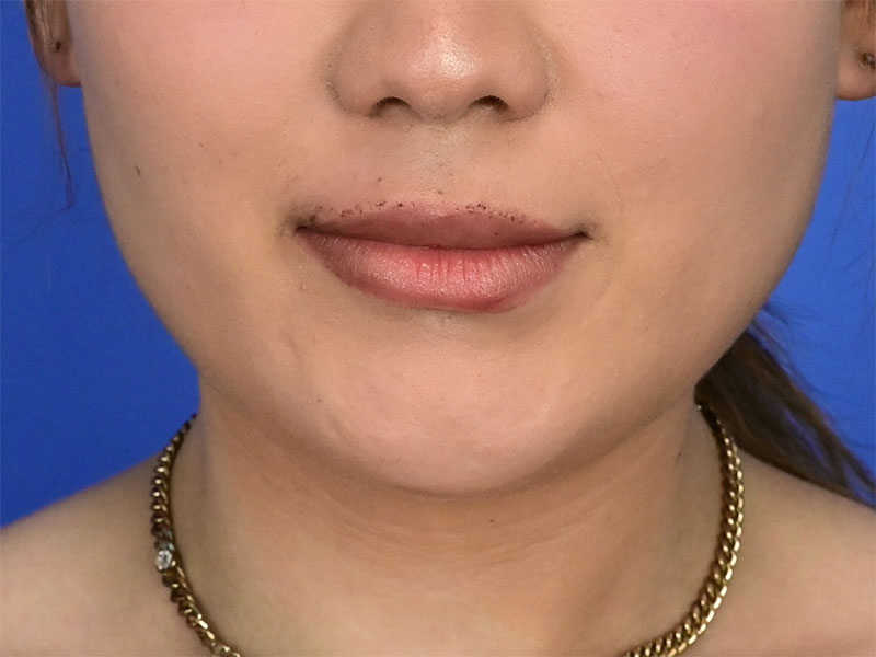 Augmentation Genioplasty Before & After Image