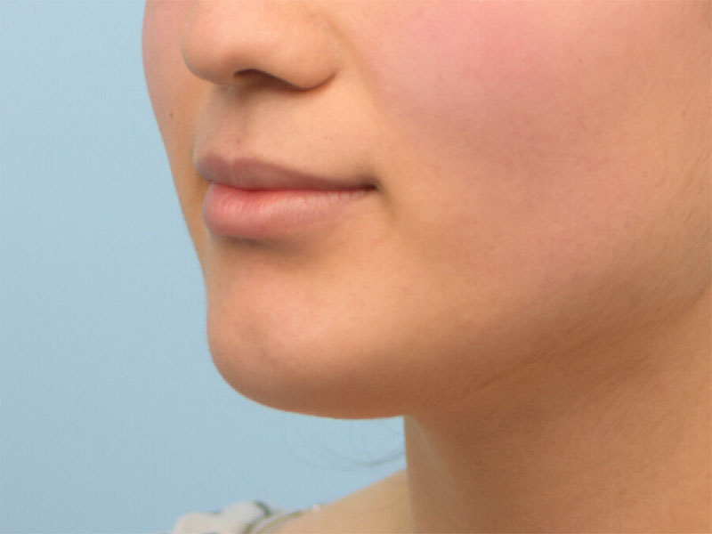 Augmentation Genioplasty Before & After Image