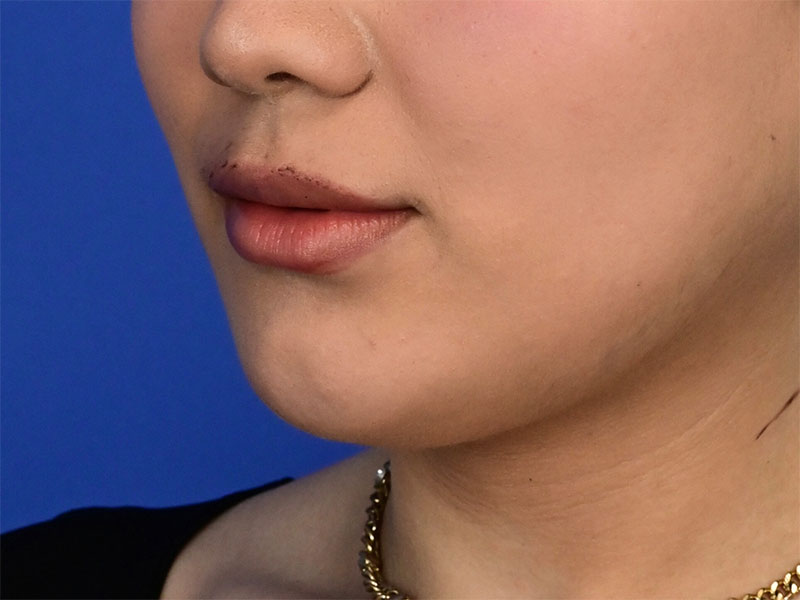 Augmentation Genioplasty Before & After Image