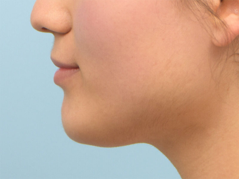Augmentation Genioplasty Before & After Image