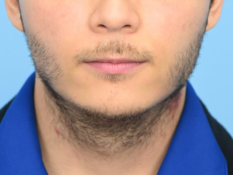 Augmentation Genioplasty Before & After Image