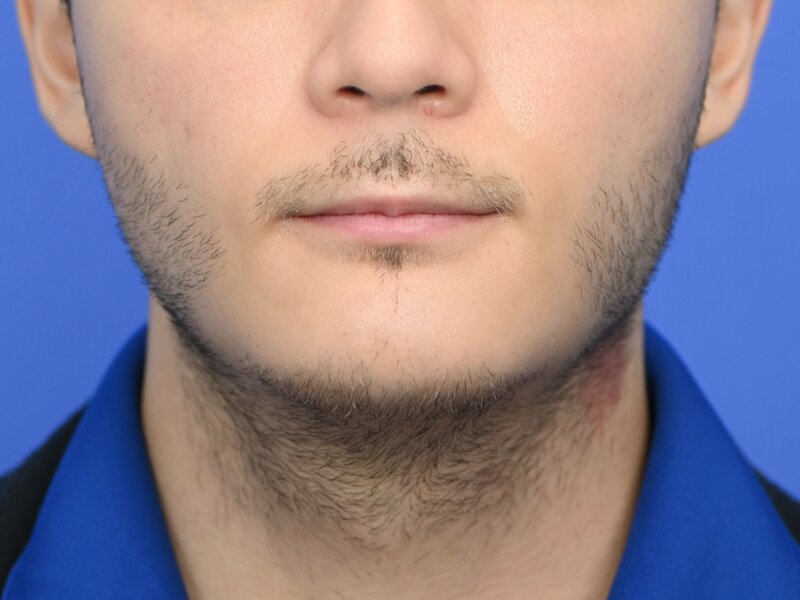 Augmentation Genioplasty Before & After Image