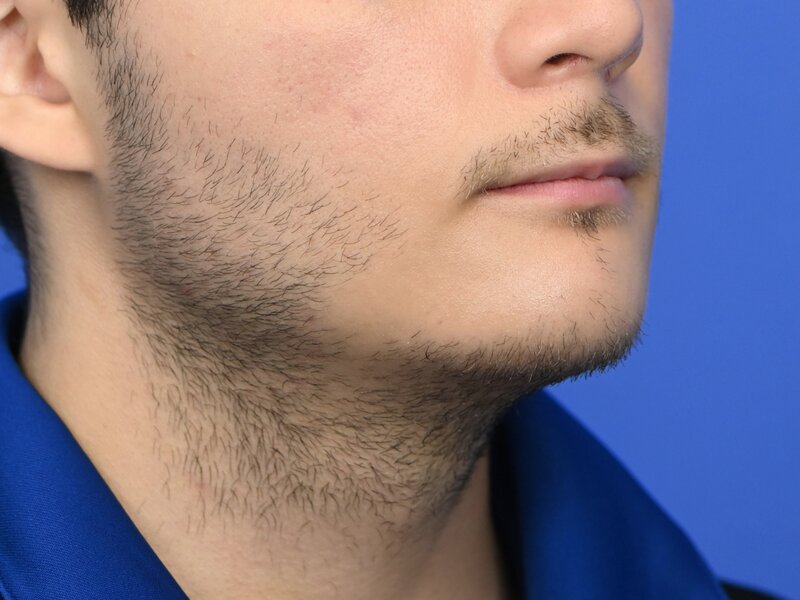 Augmentation Genioplasty Before & After Image