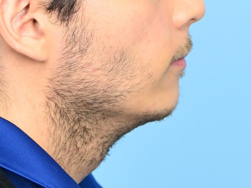 Augmentation Genioplasty Before & After Image