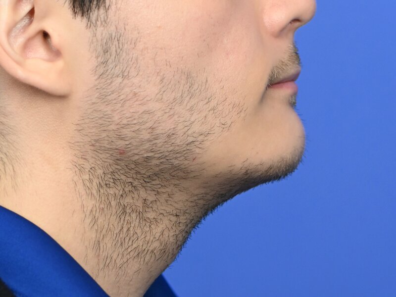 Augmentation Genioplasty Before & After Image