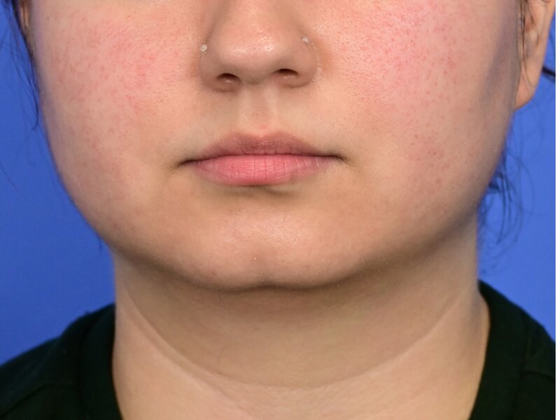 Augmentation Genioplasty Before & After Image