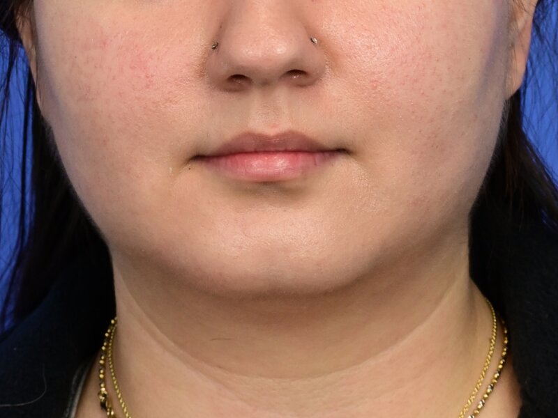 Augmentation Genioplasty Before & After Image