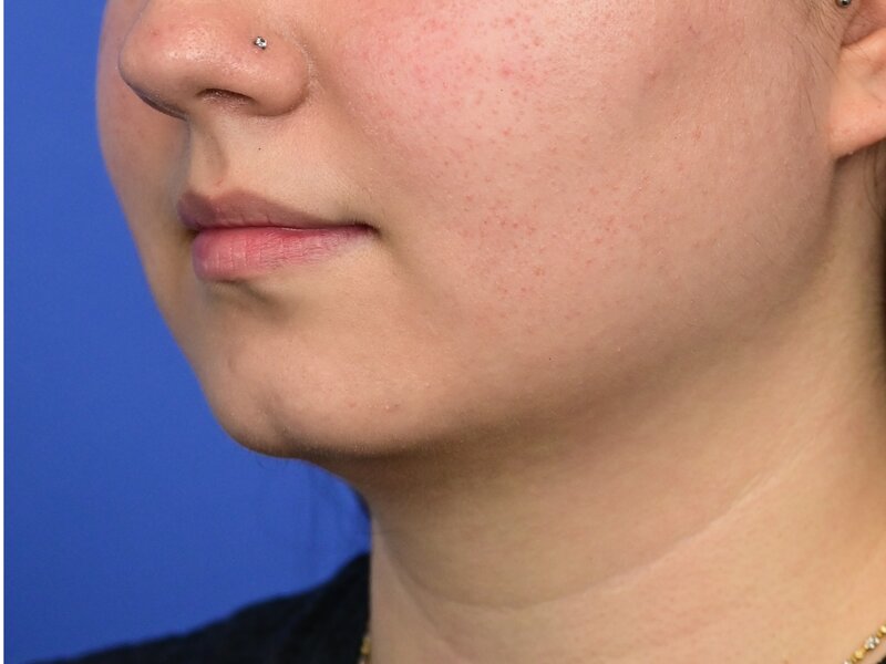 Augmentation Genioplasty Before & After Image