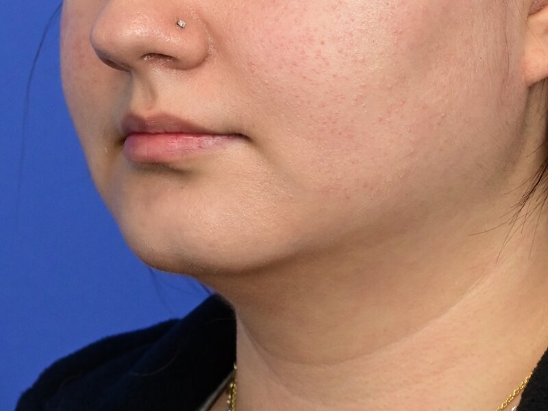 Augmentation Genioplasty Before & After Image