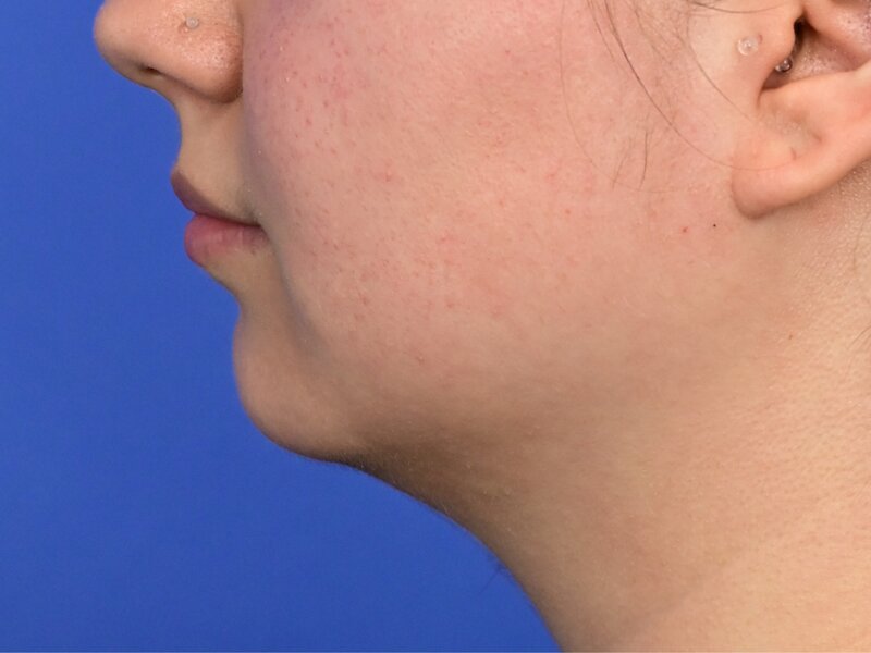 Augmentation Genioplasty Before & After Image
