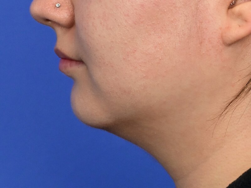 Augmentation Genioplasty Before & After Image