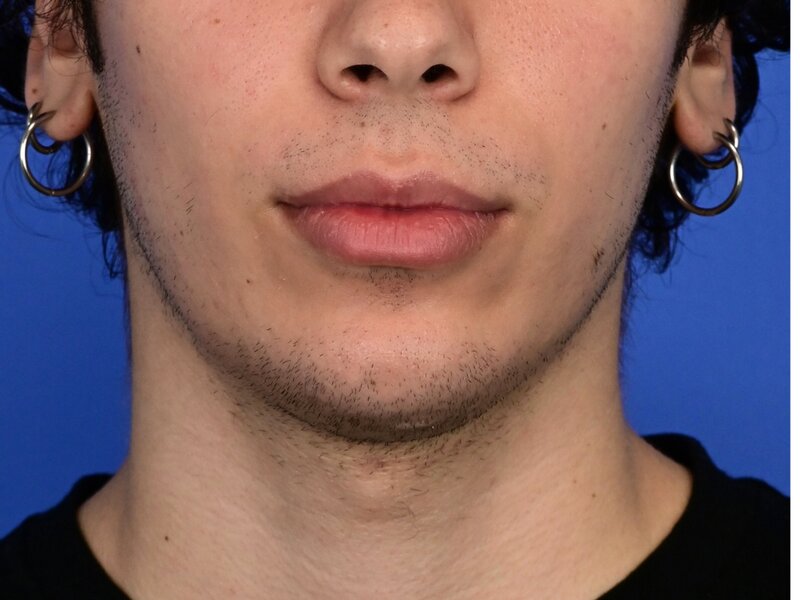 Augmentation Genioplasty Before & After Image