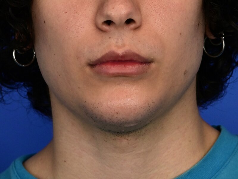 Augmentation Genioplasty Before & After Image
