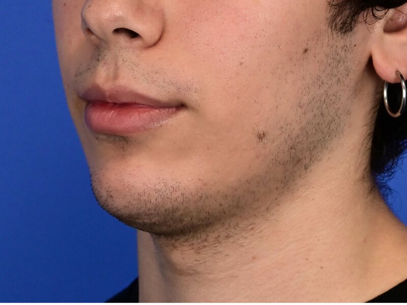 Augmentation Genioplasty Before & After Image