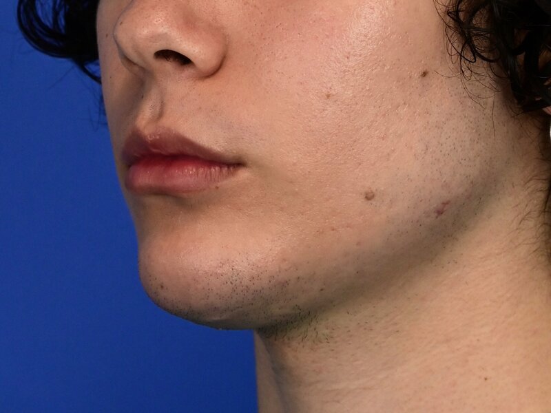 Augmentation Genioplasty Before & After Image