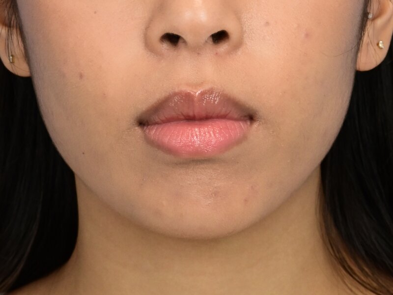 Augmentation Genioplasty Before & After Image