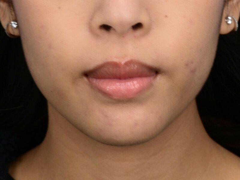 Augmentation Genioplasty Before & After Image