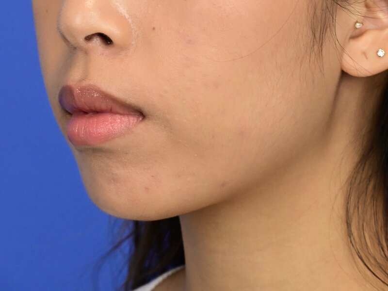 Augmentation Genioplasty Before & After Image