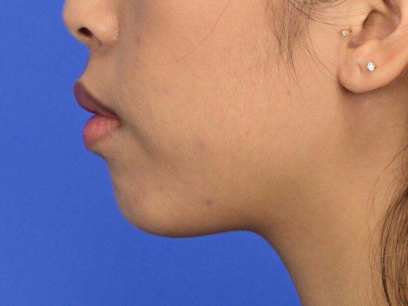 Augmentation Genioplasty Before & After Image