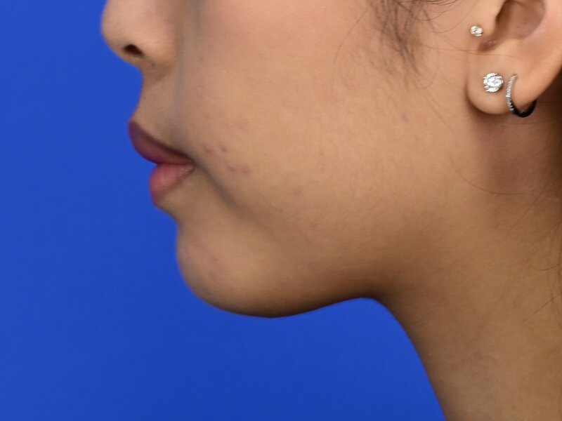 Augmentation Genioplasty Before & After Image