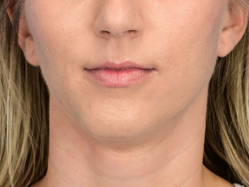 Augmentation Genioplasty Before & After Image