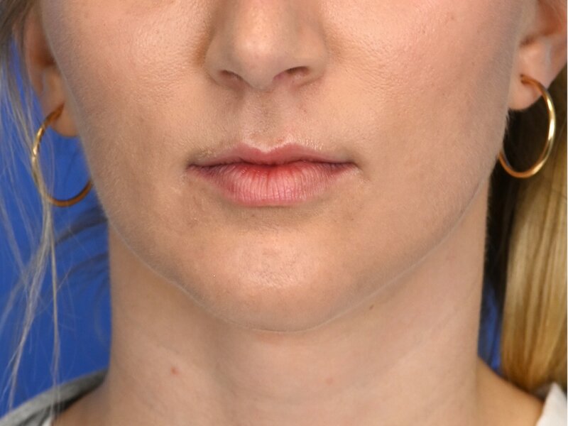 Augmentation Genioplasty Before & After Image