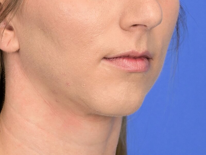 Augmentation Genioplasty Before & After Image
