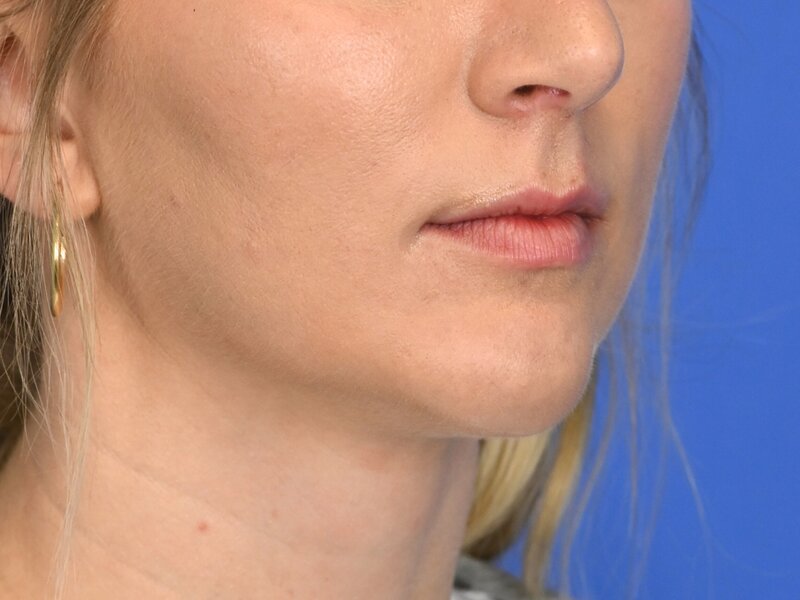Augmentation Genioplasty Before & After Image