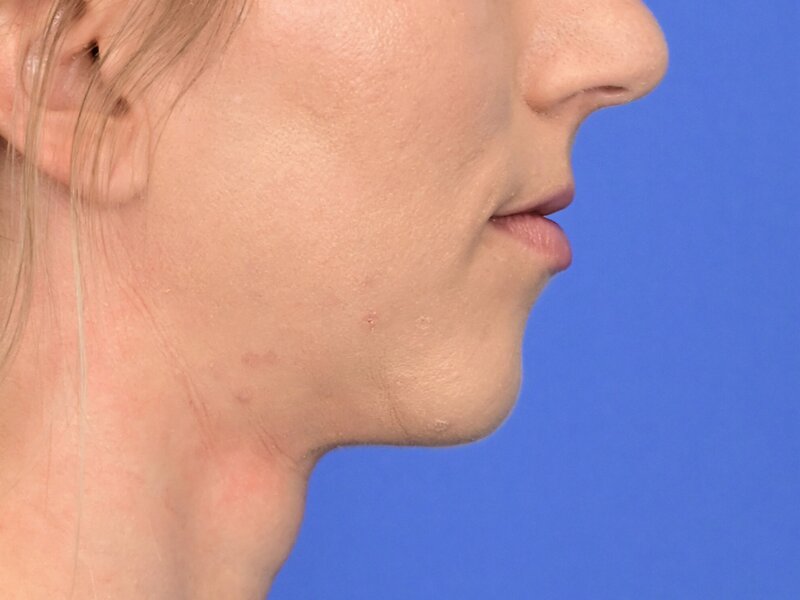 Augmentation Genioplasty Before & After Image