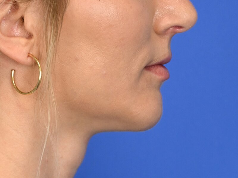 Augmentation Genioplasty Before & After Image