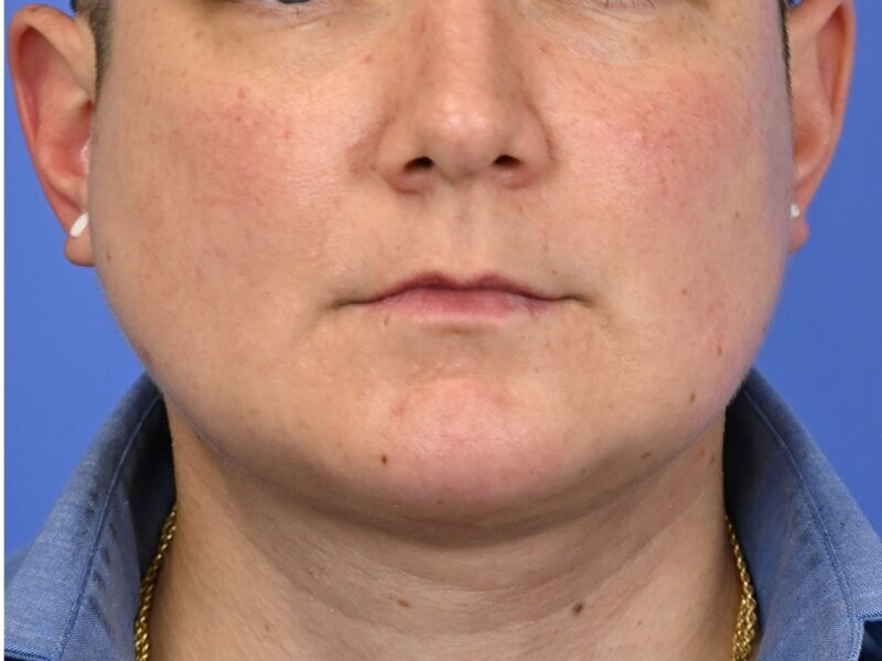 Augmentation Genioplasty Before & After Image