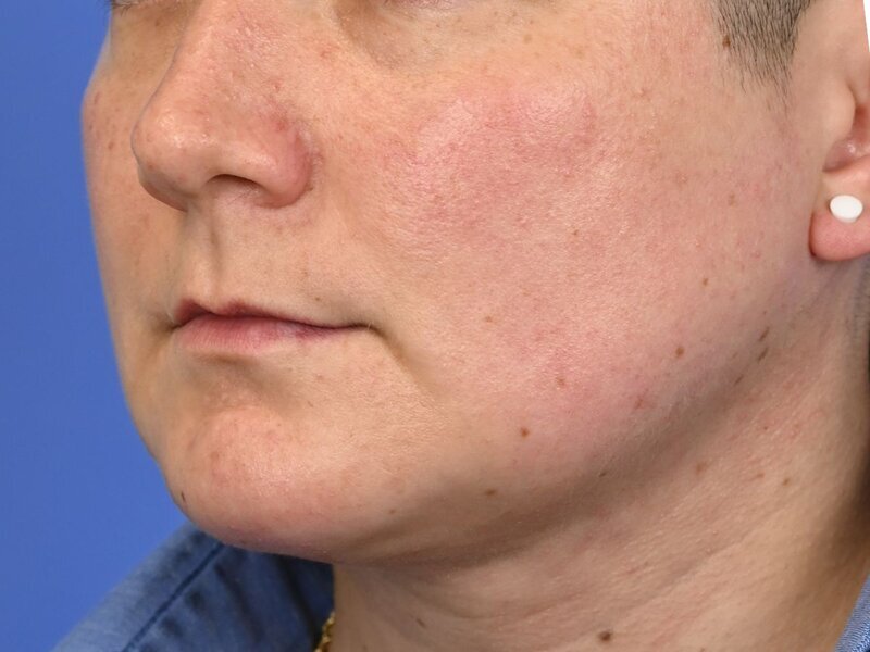 Augmentation Genioplasty Before & After Image