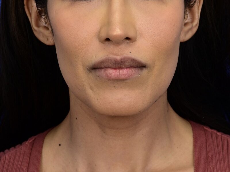 Augmentation Genioplasty Before & After Image