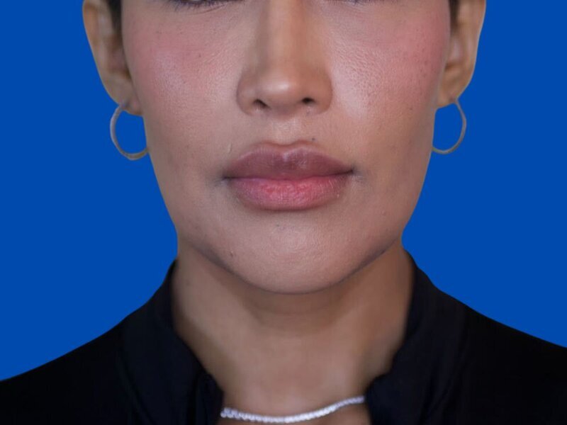 Augmentation Genioplasty Before & After Image