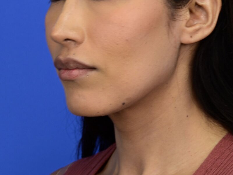 Augmentation Genioplasty Before & After Image