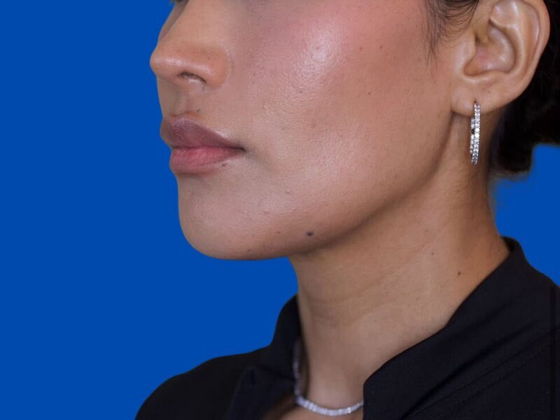 Augmentation Genioplasty Before & After Image