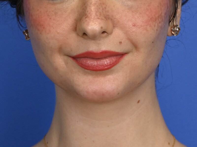 Augmentation Genioplasty Before & After Image