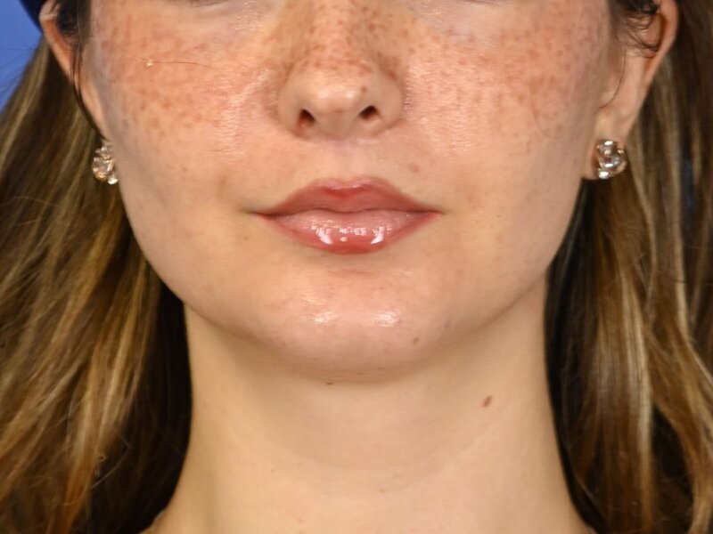 Augmentation Genioplasty Before & After Image
