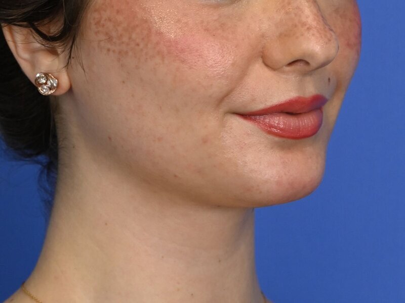 Augmentation Genioplasty Before & After Image
