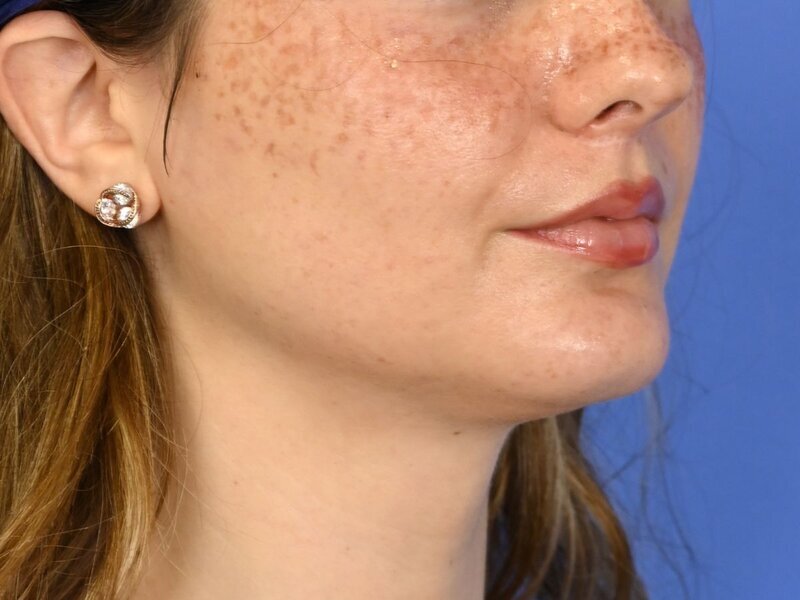 Augmentation Genioplasty Before & After Image