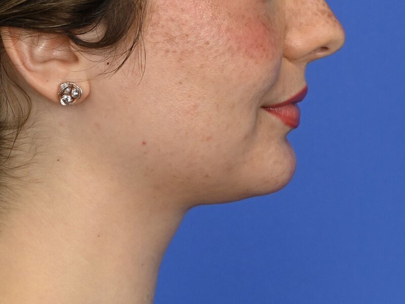 Augmentation Genioplasty Before & After Image
