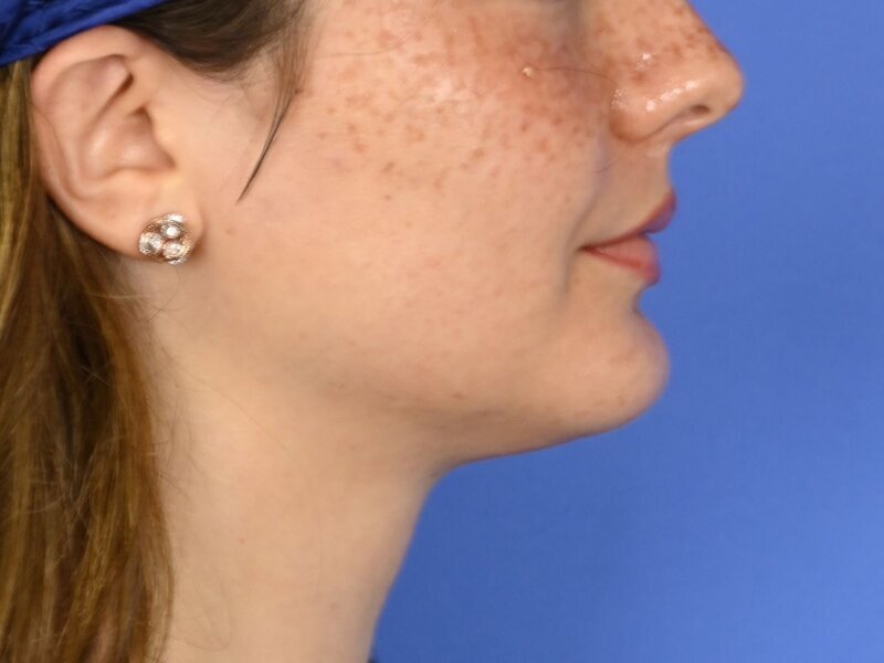 Augmentation Genioplasty Before & After Image