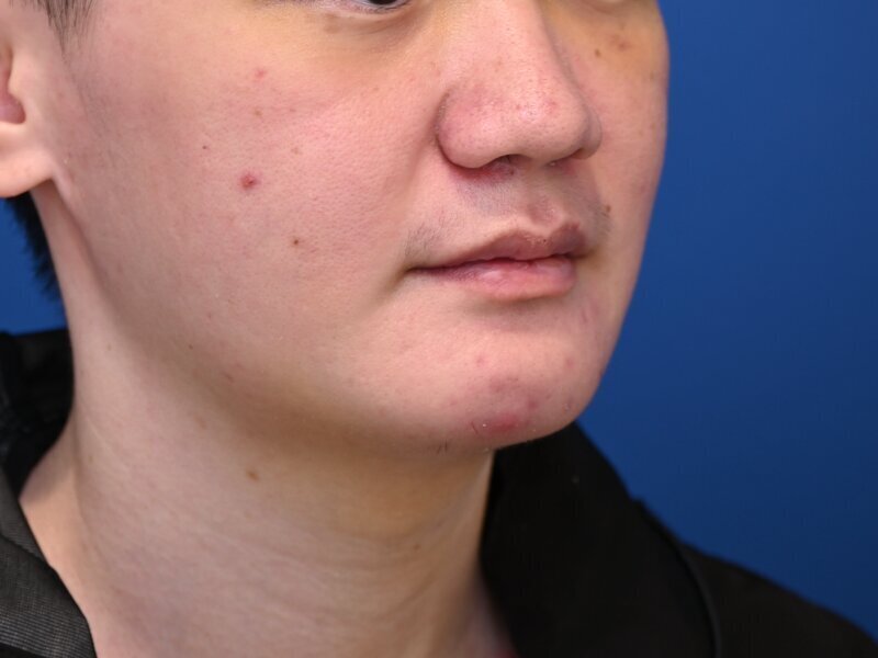 Augmentation Genioplasty Before & After Image