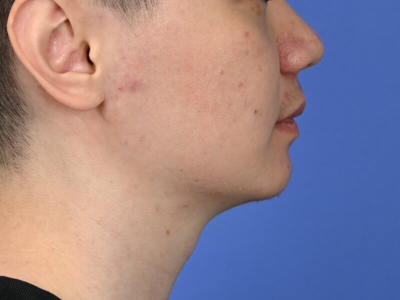 Augmentation Genioplasty Before & After Image