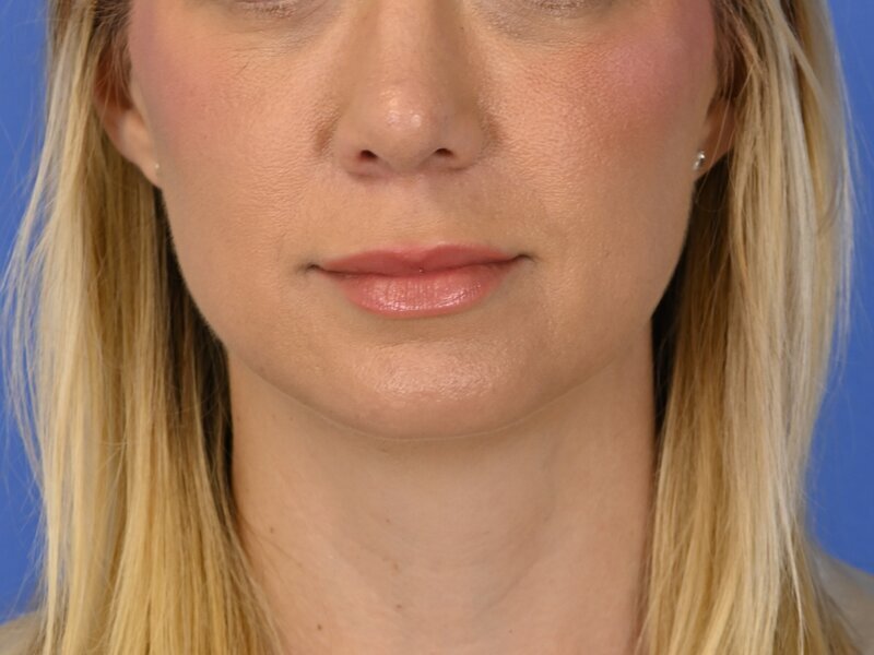 Augmentation Genioplasty Before & After Image