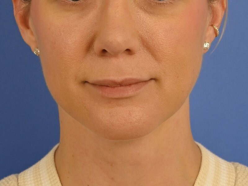 Augmentation Genioplasty Before & After Image