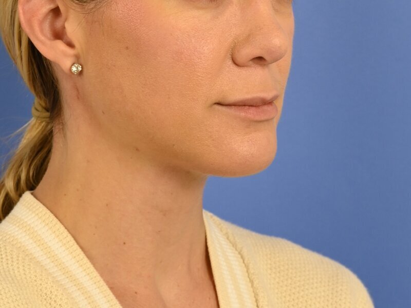 Augmentation Genioplasty Before & After Image