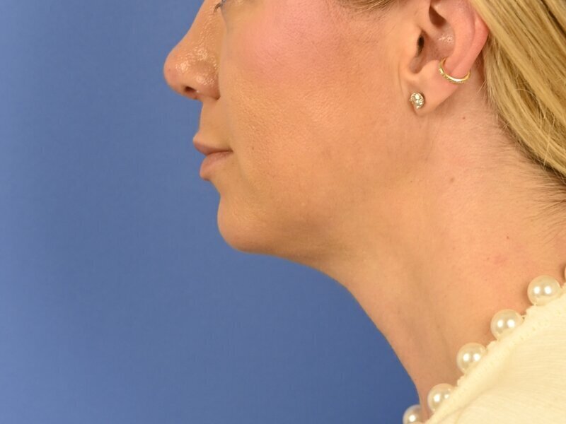 Augmentation Genioplasty Before & After Image
