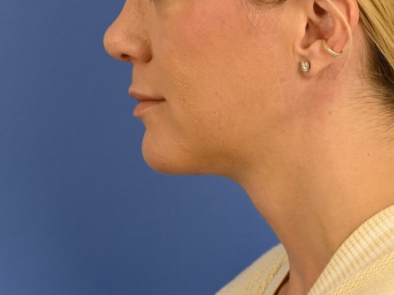 Augmentation Genioplasty Before & After Image